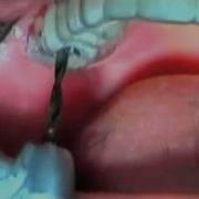 Basic Implant