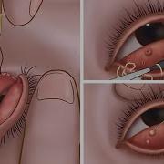 Asmr Eyelid Seburn Extrusion End Stone Removal