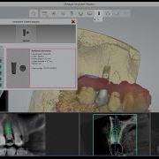 Digital Implant Planning Surgical Guide Design 3Shape Implant Studio