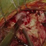 Retromastoid Craniotomy