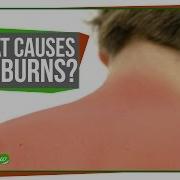 Another Sunburn